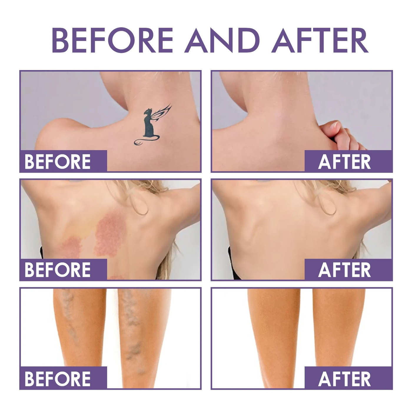 Before and after on tattoos, marks and veins